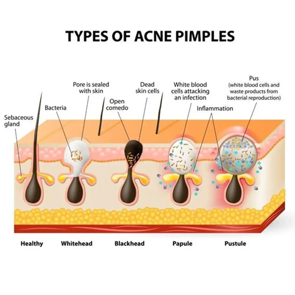 Blackhead Nose Patch Strips
