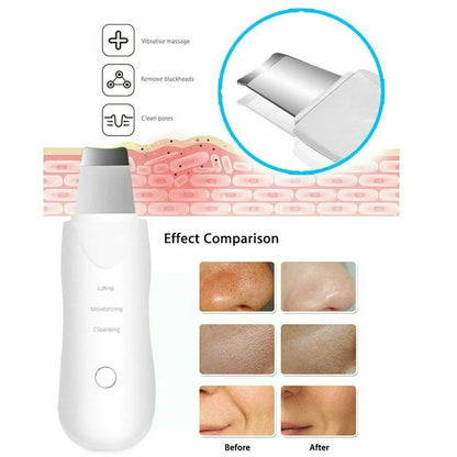 Ultrasonic Blackhead Scrubber
